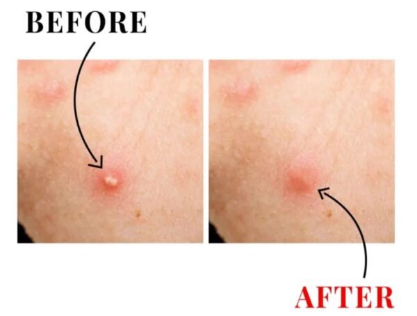 Acne Spot Patches – Invisible Hydrocolloid Blemish Treatment - Image 3