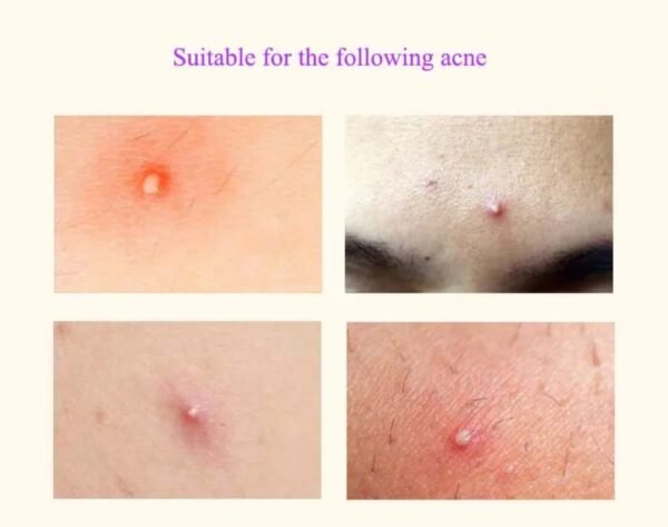 Acne Spot Patches – Invisible Hydrocolloid Blemish Treatment - Image 8
