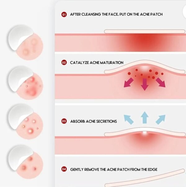 Acne Spot Patches – Invisible Hydrocolloid Blemish Treatment - Image 4