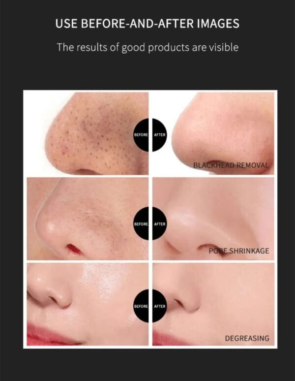 Nose Blackhead & Whitehead Removal Pore Shrinking Mask Patch - Image 5